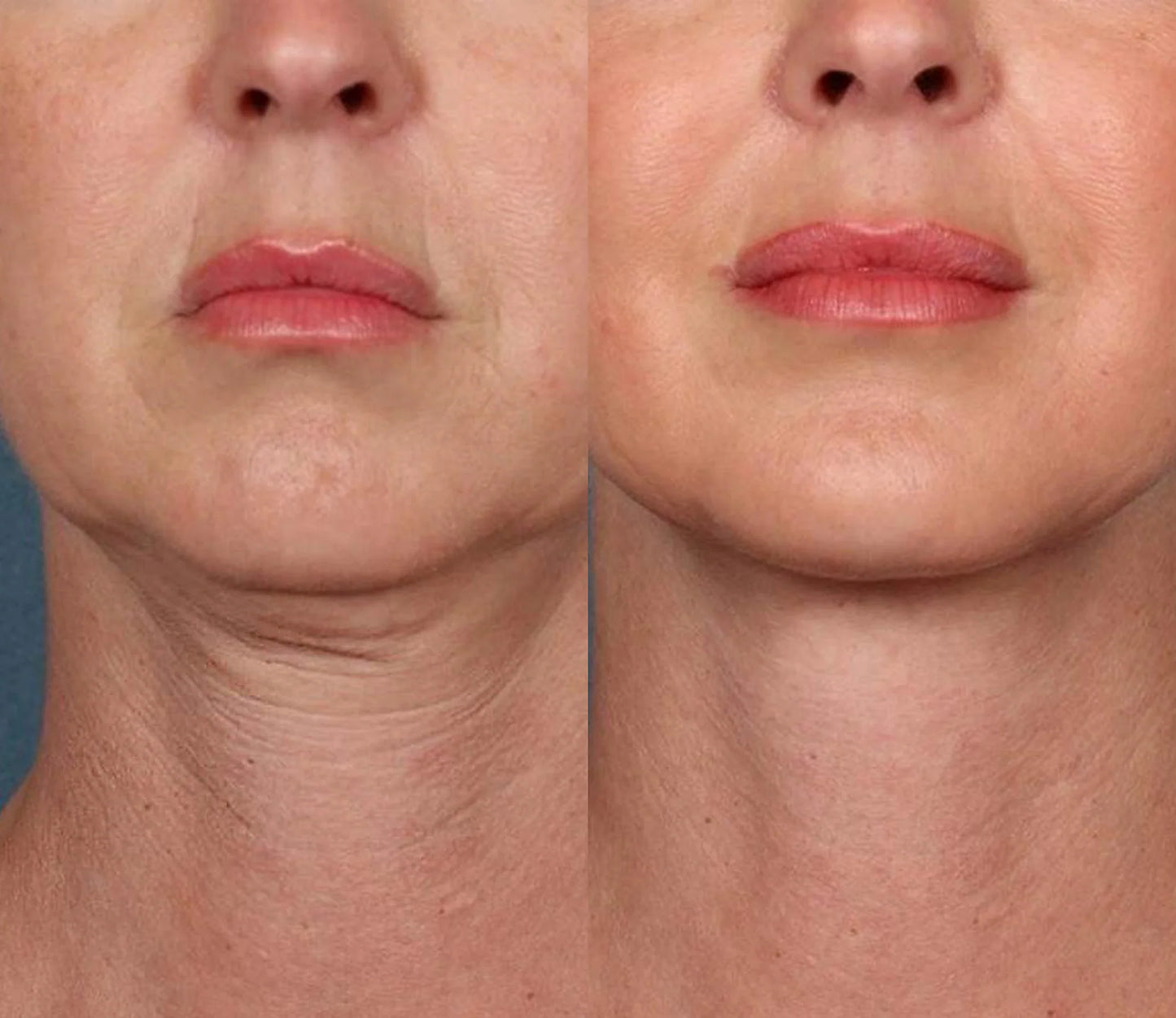 Natravor® Instant Wrinkle-Reducing Natural Cream